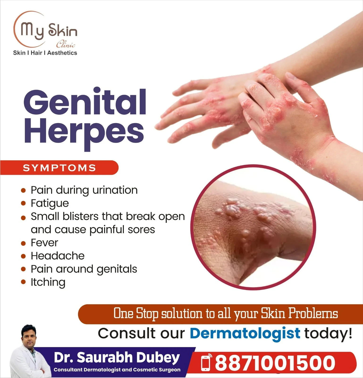 Genital Herpes Treatment in Indore